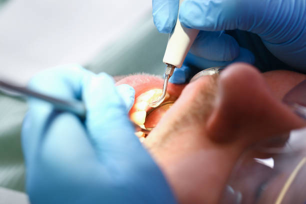 Best Emergency Wisdom Teeth Removal in Knox, PA